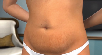 Will Tummy-Tuck Recovery Be Difficult?