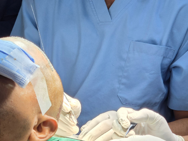 hair-restoration-recipient-site-technique