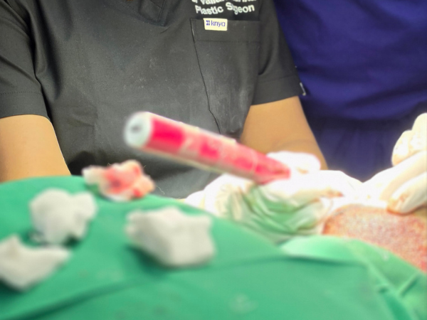 hair-transplant-graft-implantation-closeup