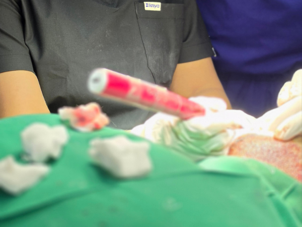 hair-transplant-graft-implantation-implanter-pen-close-up