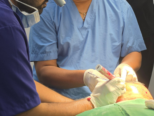 hair-transplant-graft-implantation-surgical-loupes-training