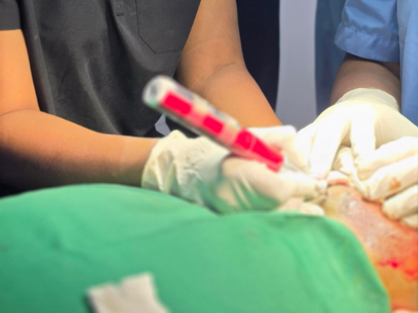 hair-transplant-graft-implanter-pen-hands-on-training