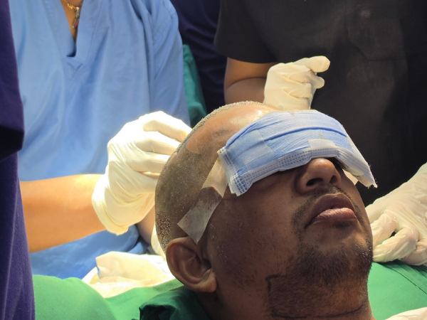 hair-transplant-recipient-area-preparation
