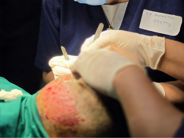 hair-transplant-recipient-site-implantation-closeup