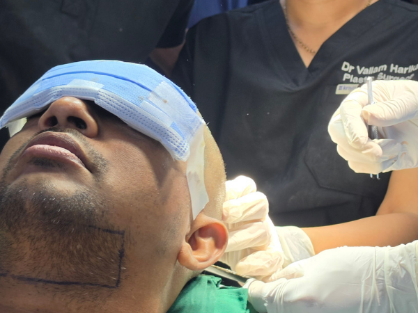 hair-transplant-recipient-site-marking