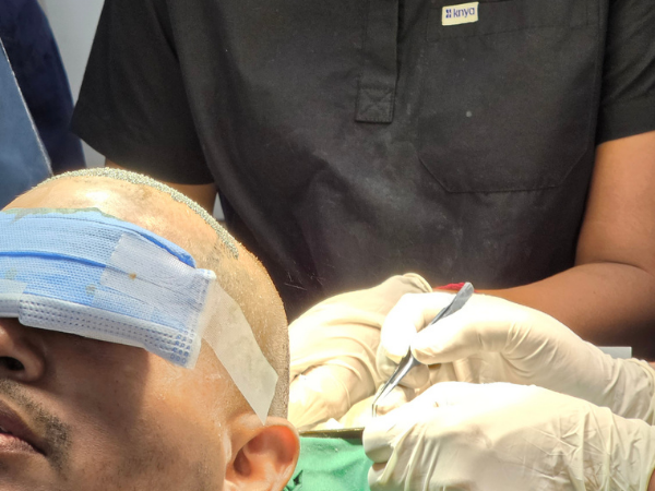 hair-transplant-surgeon-loupes-implantation-training-close-up