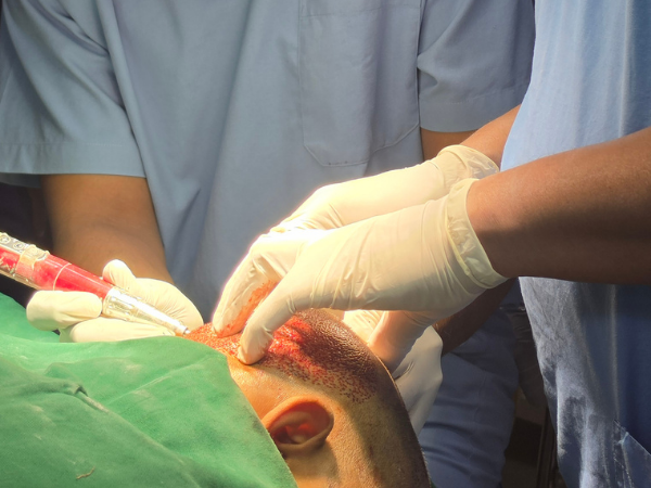 hair-transplant-surgeon-loupes-live-surgery-demonstration