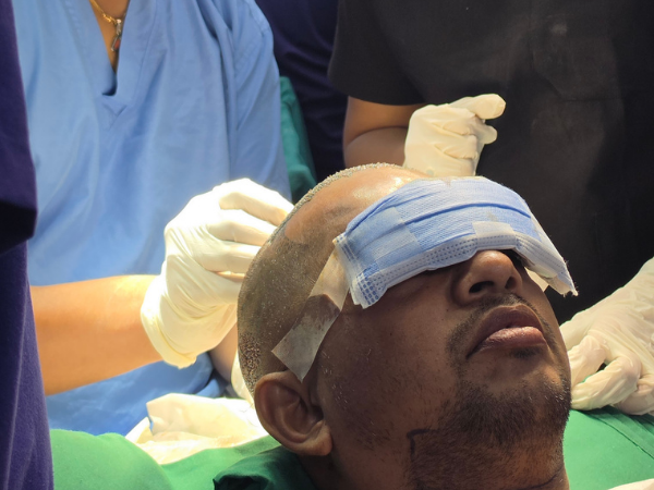 hair-transplant-surgeon-surgical-loupes-headlight-training