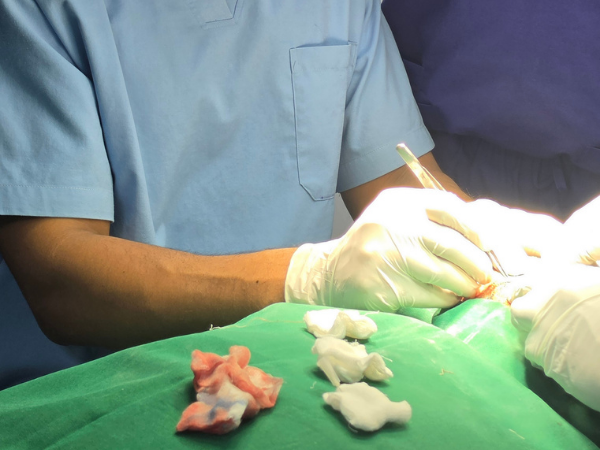 hair-transplant-trainee-surgical-loupes-live-surgery